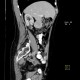 GIST of duodenum, gastrointestinal stromal tumour: CT - Computed tomography